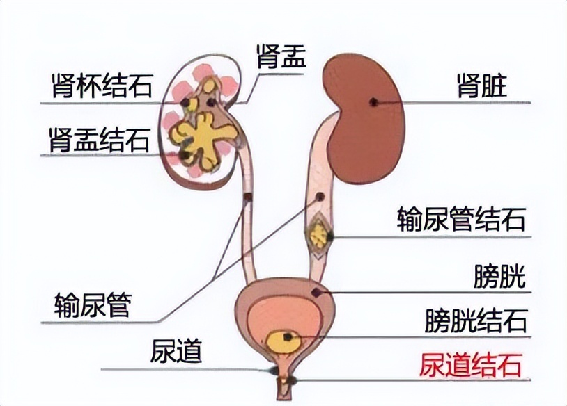 人体尿路结石结构图图片