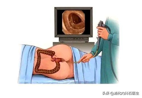 肠镜检查发现结肠息肉3个，做手术时却发现5个，为什么？
