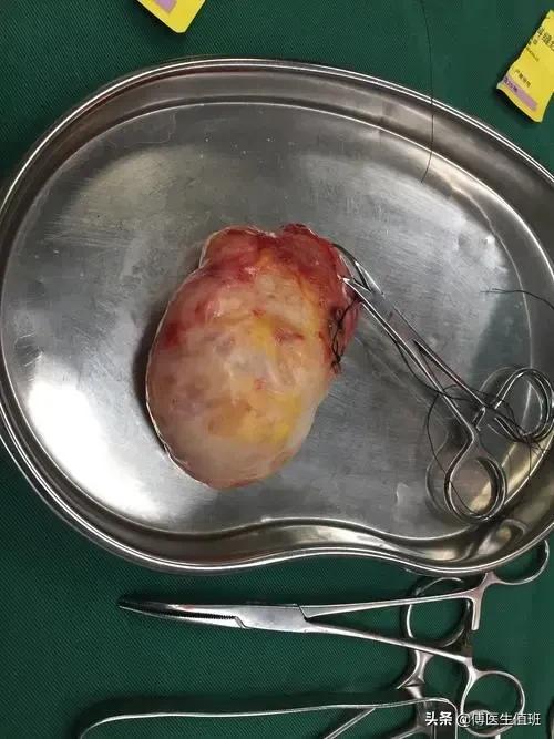 13岁女孩胸部肿块,父母为重视,快速长大后手术切除化验:肿瘤