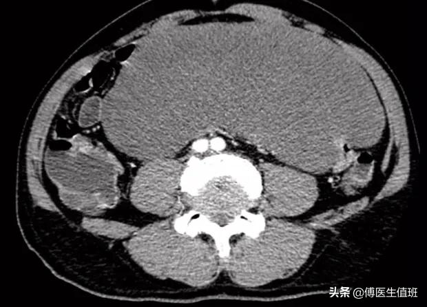 男子腰背部疼痛，就医发现腹腔占位，手术中护士惊呼：太少见了