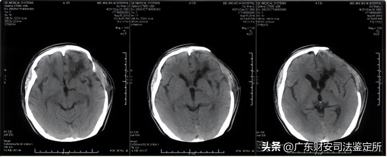 司法鉴定所对高坠伤致头面部损伤的法医临床鉴定
