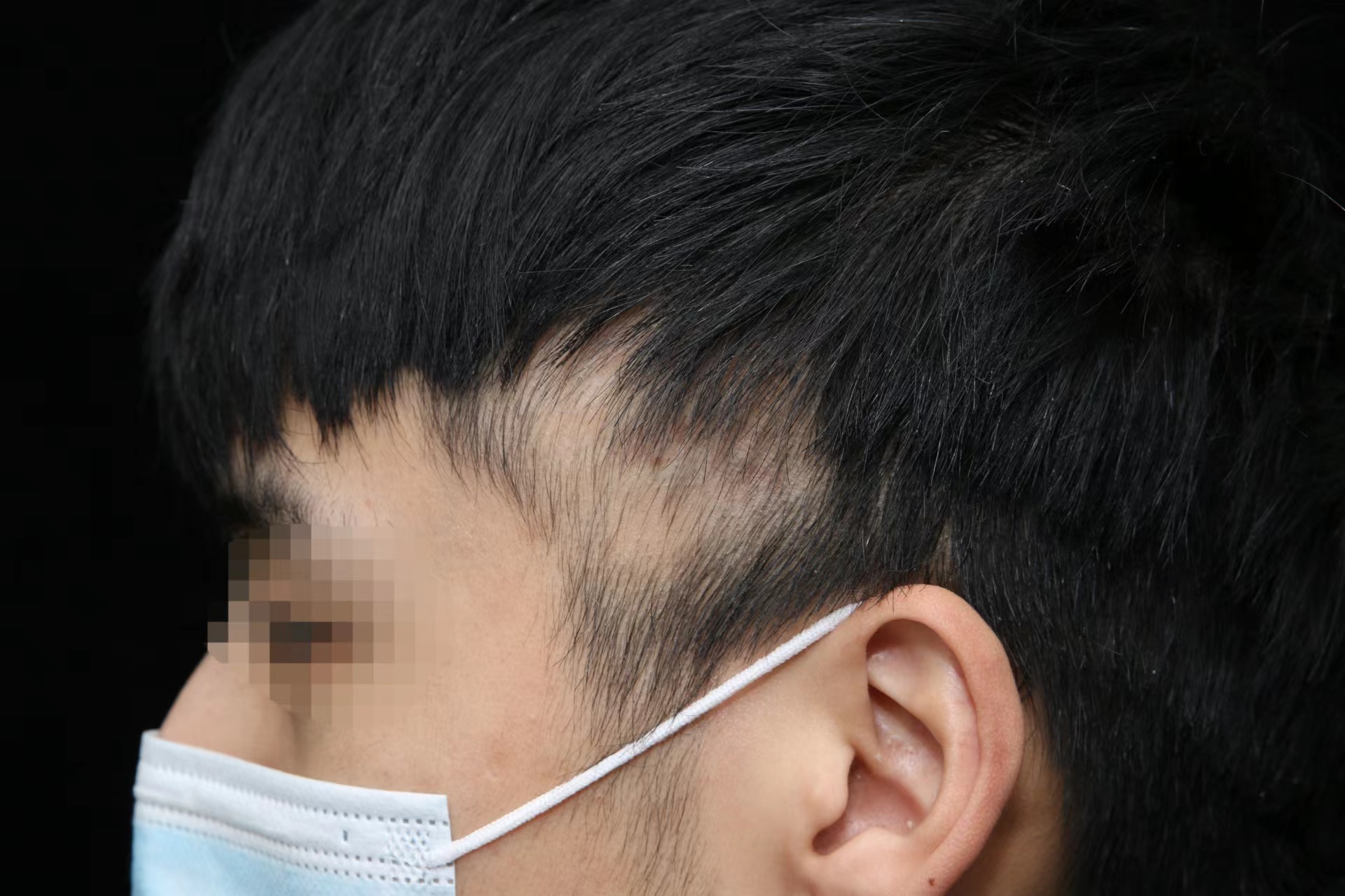 治斑秃，怎么越治越秃？