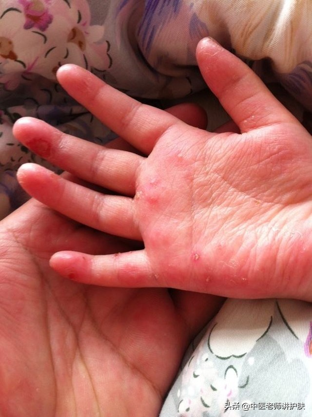 婴儿慢性湿疹(急性湿疹和慢性湿疹有什么区别) - 乐宝宝贝