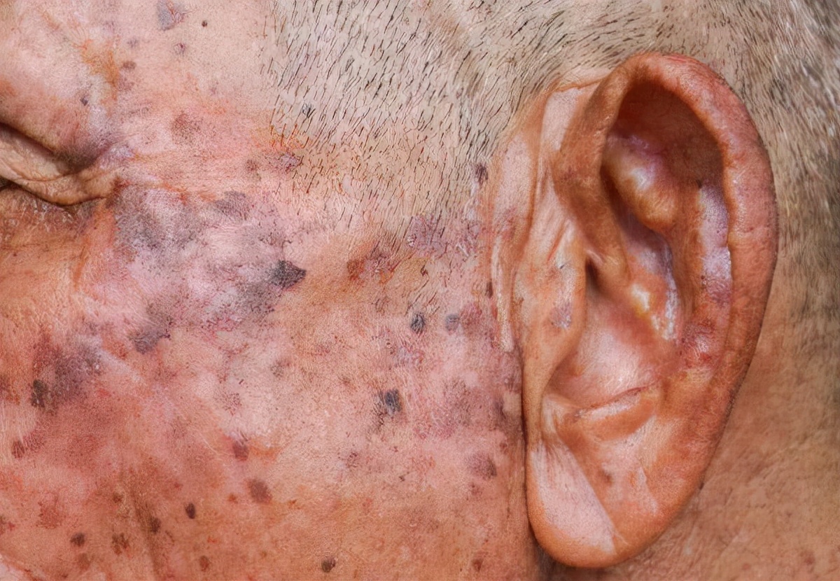 不想满脸长老年斑？学会这3招，让你拥有好气色