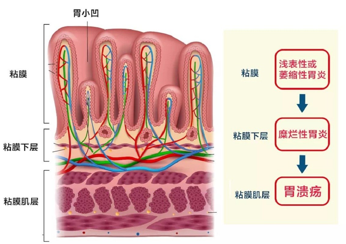酸性越强腐蚀性就越强吗？胃酸PH2.5左右，为什么对人体没有伤害