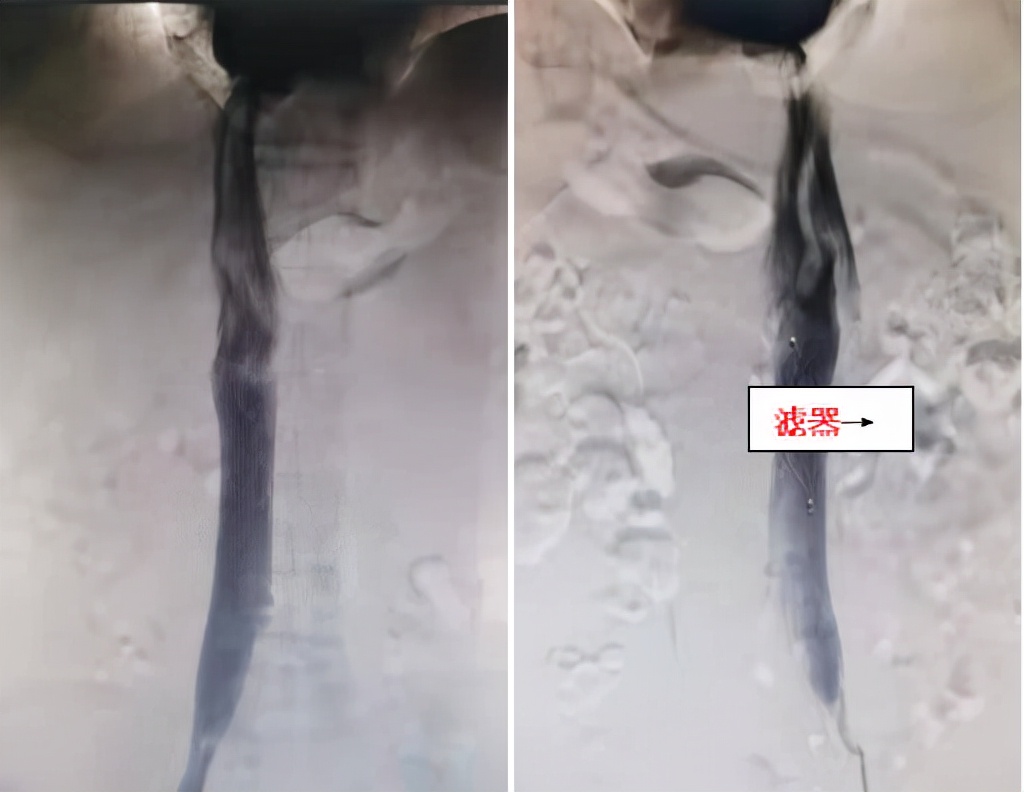 六旬老人下肢疼痛肿胀 一站式介入手术为患者“解围”
