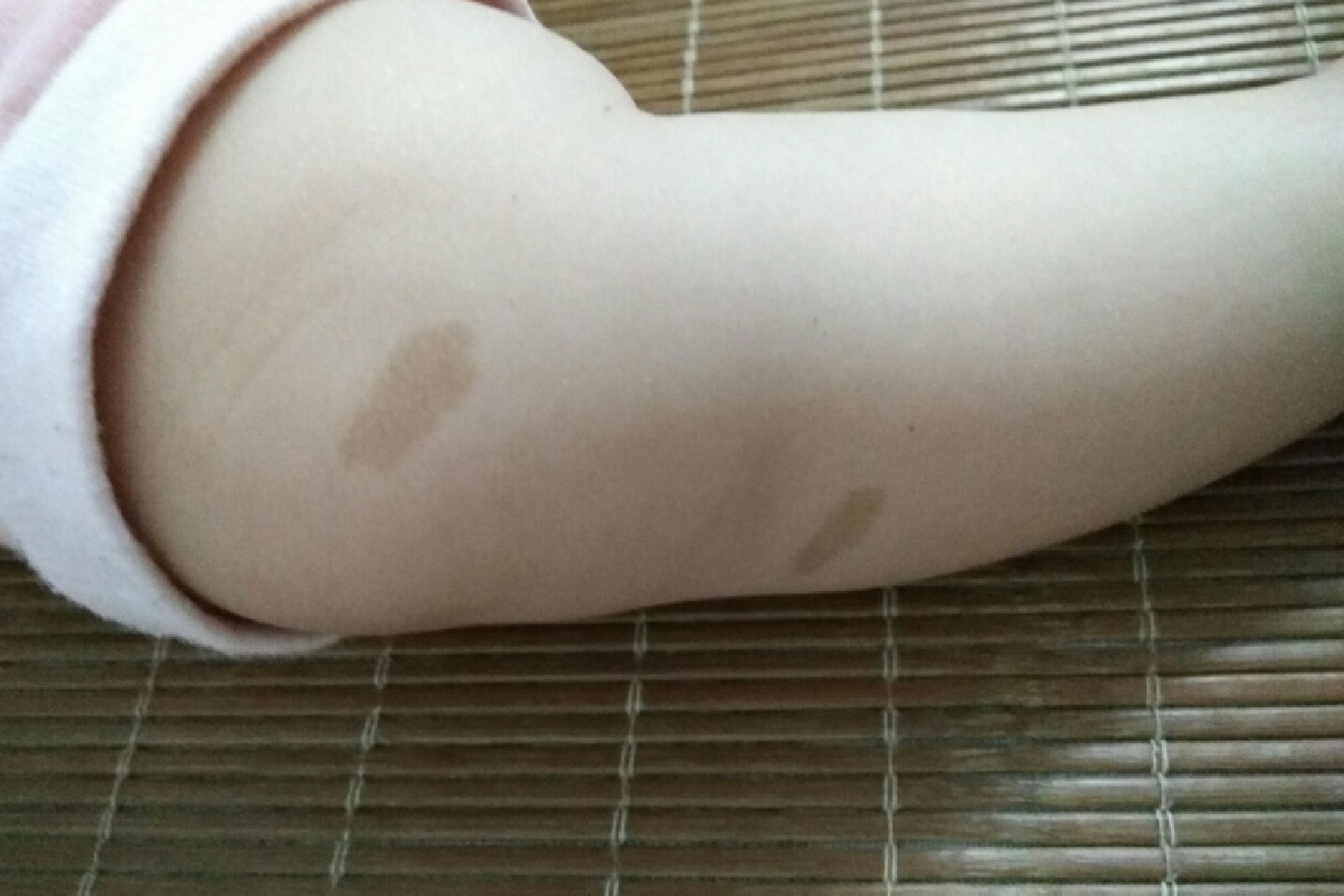 咖啡牛奶斑图片婴儿(宝宝的胎记) - 乐宝宝贝