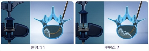 金堂县二医院骨科成功开展县内首例经皮穿刺弯角椎体成形手术