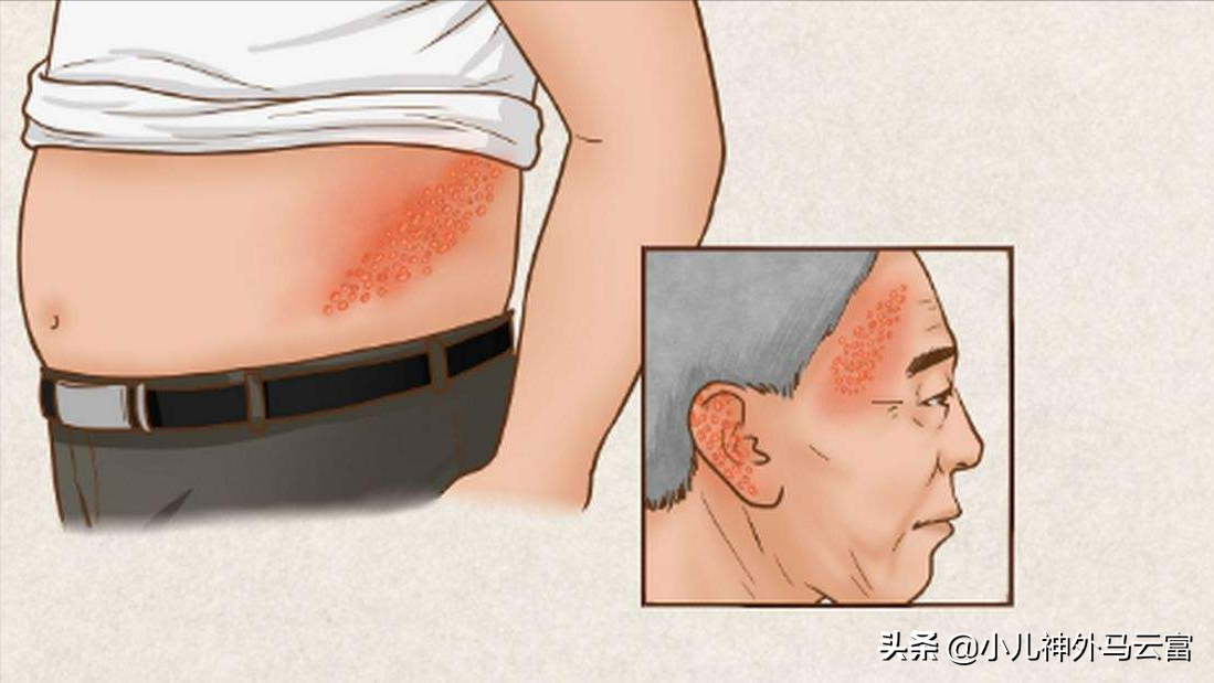 有一种痛叫"带状疱疹",和水痘有什么区别?又该如何预防?