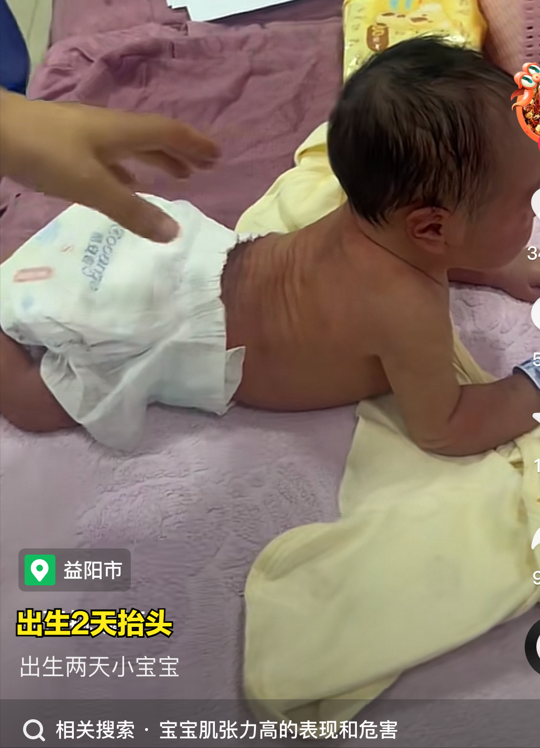 出生2天宝宝能抬头被疑肌张力高，怎么回事？肌张力高怎么判断