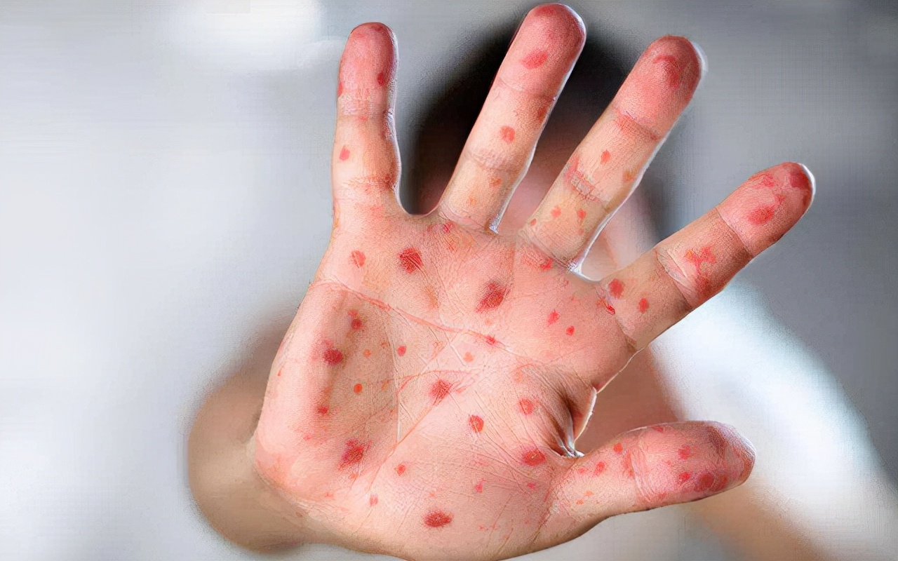 轻微紫癜的症状图片(解疑答惑) - 赤虎壹号