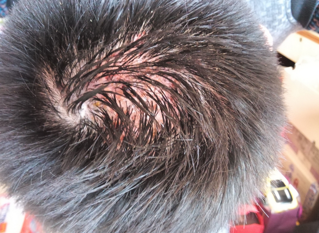 为啥头皮总长"脓包"和"疙瘩"?医生坦言:或许和5个原因有关