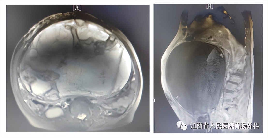 仁医医术| 鲐背老人“拆弹记”