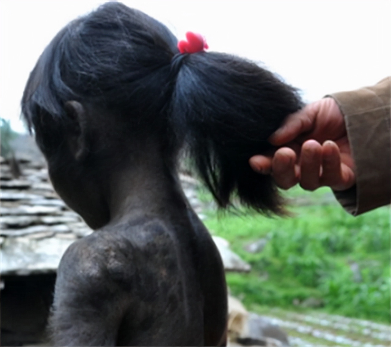女孩60%皮肤布满黑毛,2岁遭父母抛弃,被同龄人取小猴子外号