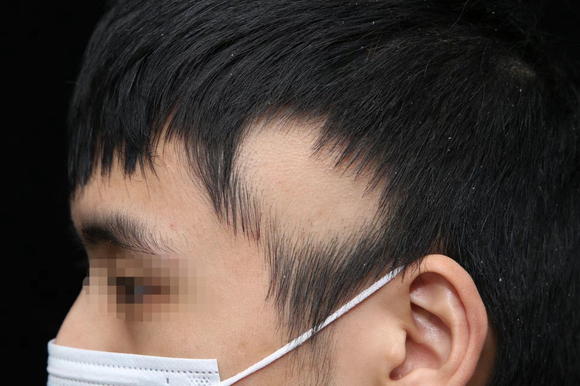 治斑秃，怎么越治越秃？
