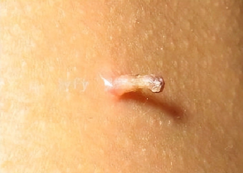 疣,是感染人乳头瘤病毒也就是hpv引起的一种皮肤表面赘生物,可以发生