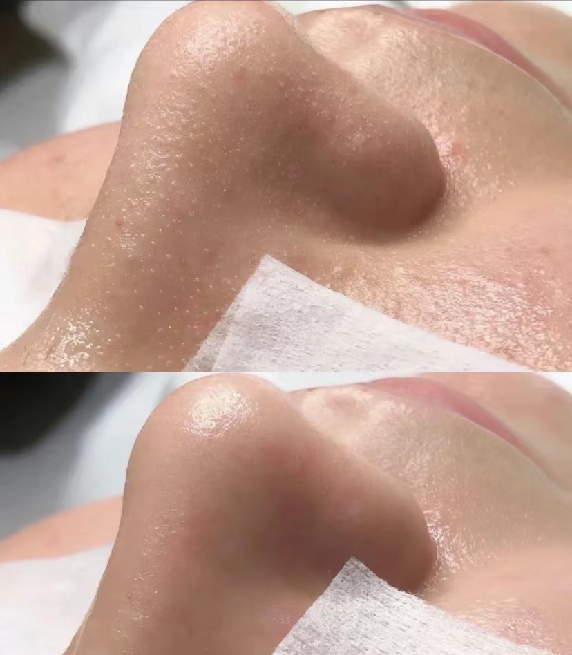 为什么这么多人疯狂的跑美容院做"毛孔清洁",真的能去黑头吗?