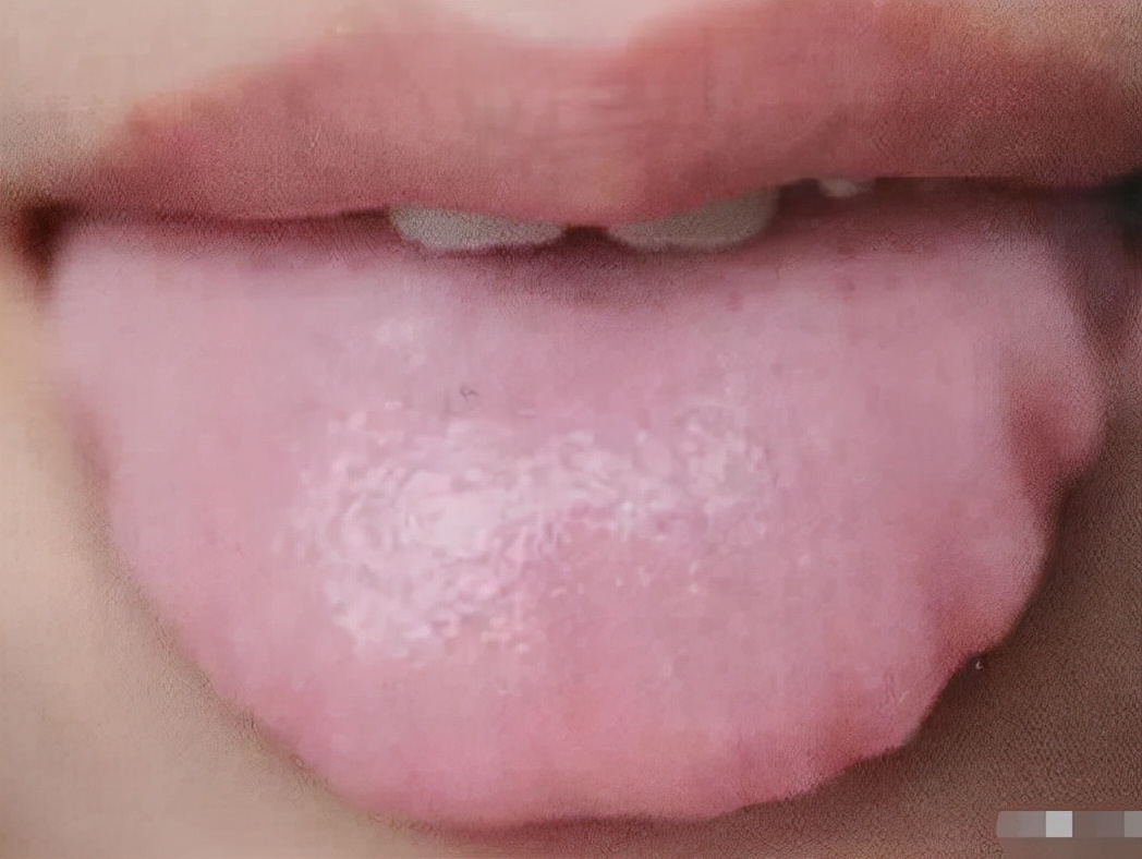 舌头边缘有齿痕，舌苔中间有裂纹？3种齿痕5种裂纹，你是哪一种？