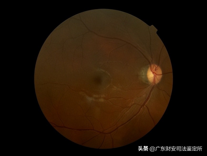 司法鉴定所对高坠伤致头面部损伤的法医临床鉴定