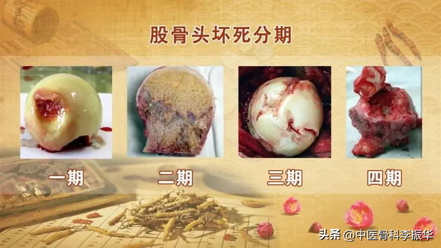 股骨头坏死目前治疗有什么良方(我的股骨头坏死了)
