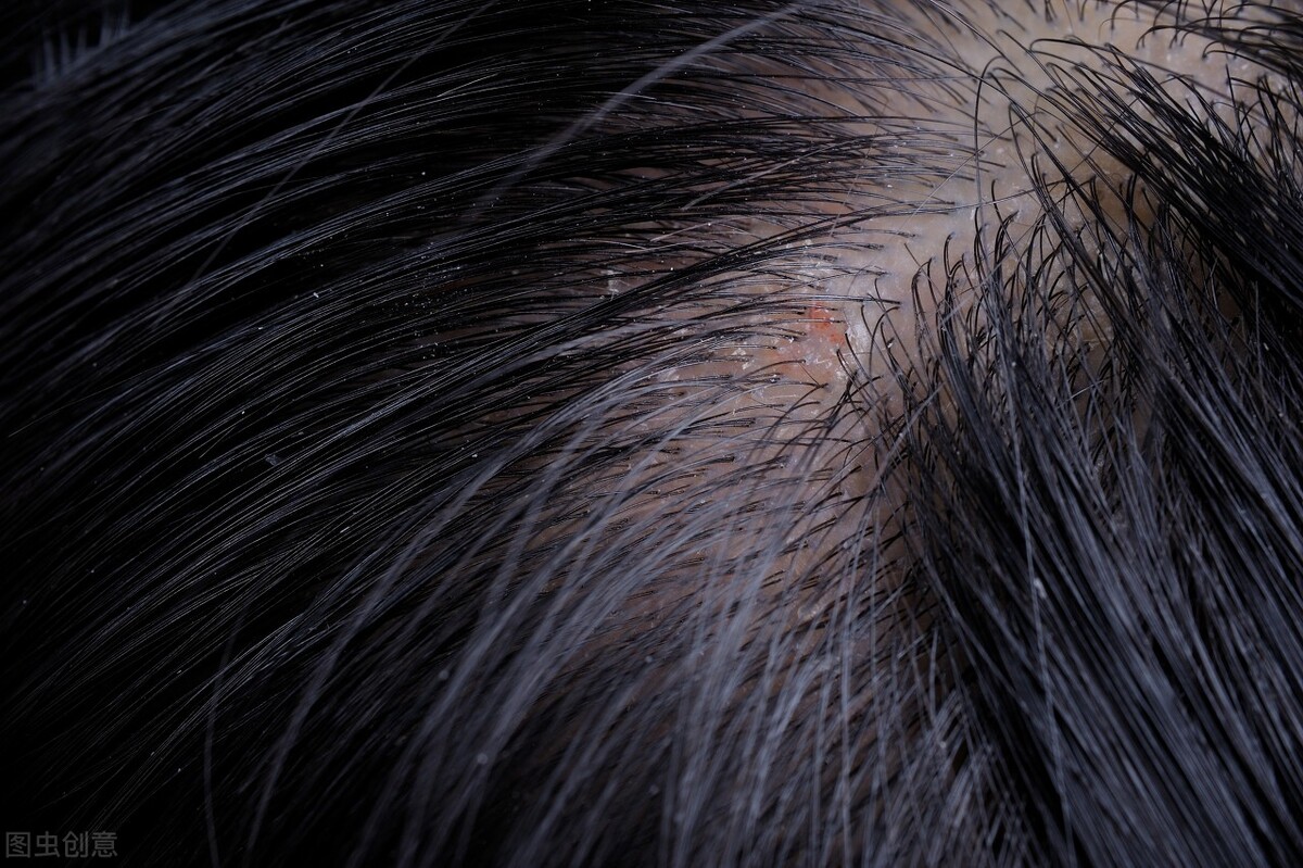 抓不住洗发水多少钱头皮总长疙瘩和脓包是怎么回事