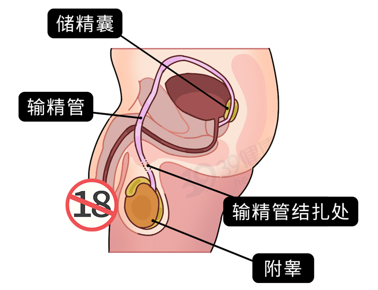 男性结扎和女性结扎，哪个伤害更大？男性结扎会降低性能力吗？