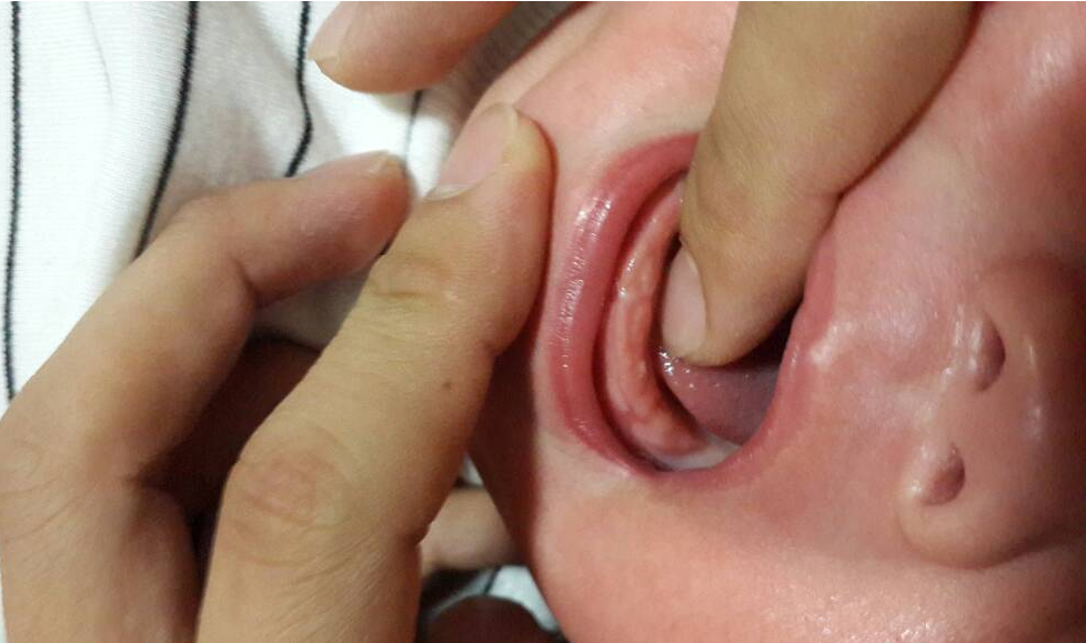 三个月宝宝马牙图片(宝宝长牙时的症状) 