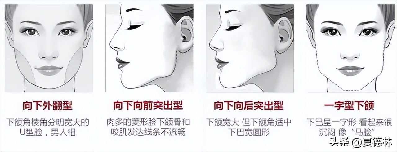 1,更自然下颌角整形中保留下颌角的话,从侧面看还是有角度的存在,更