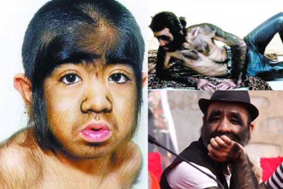 "中国第一毛孩"于震寰:42岁为娶娇妻被逼脱毛,儿子长相如何?