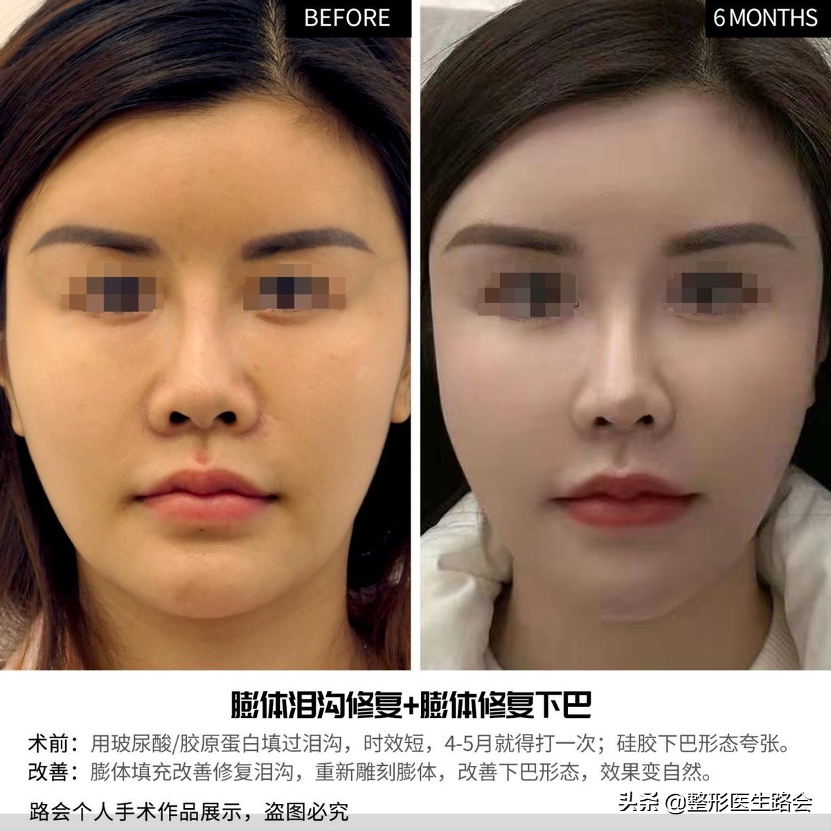 下巴整容需要多少钱(32岁下巴修复) - 价格百科