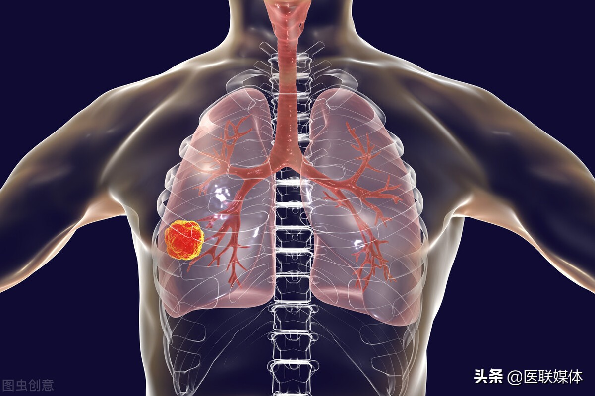 肺部结节是怎么形成的（明明自己不抽烟）