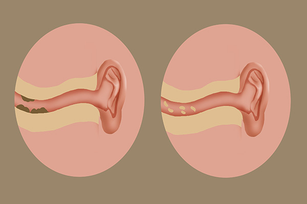 为什么有的人耳屎是干的，有的是湿的？耳屎到底用不用掏？