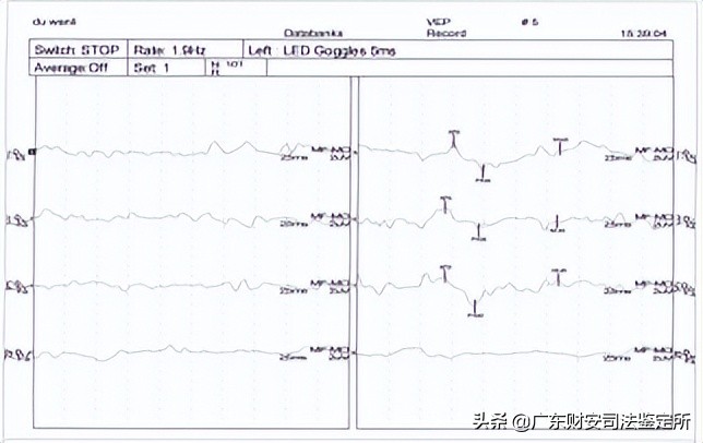 司法鉴定所对高坠伤致头面部损伤的法医临床鉴定