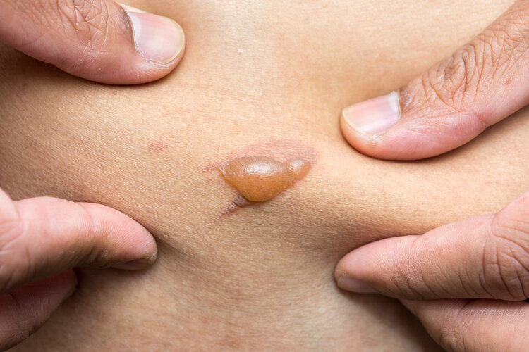 拔火罐吸出来的淤血，是体内的毒素？将大实话告诉你，看完涨知识