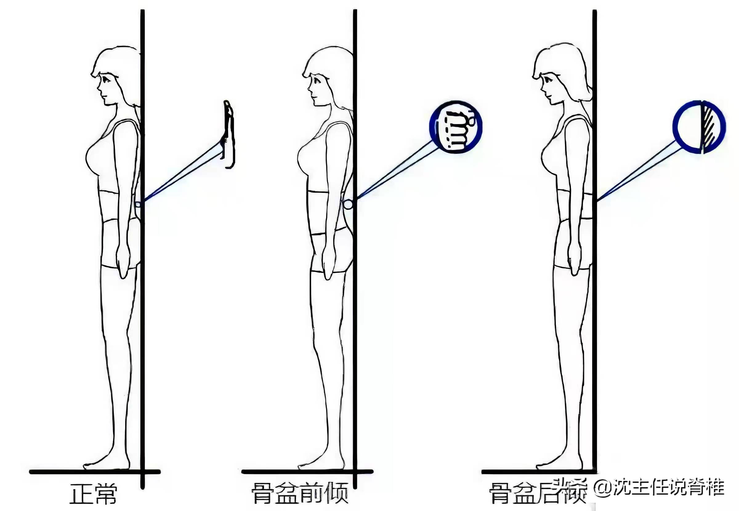 燕子飞动作图（腰椎间盘突出练习小燕飞的作用）