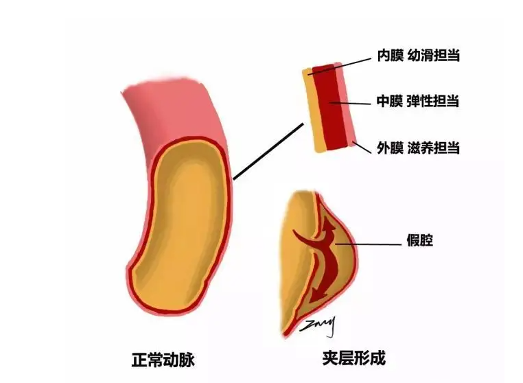 胸疼难忍，以为心梗，医生说比心肌梗死重10倍！基本无力回天