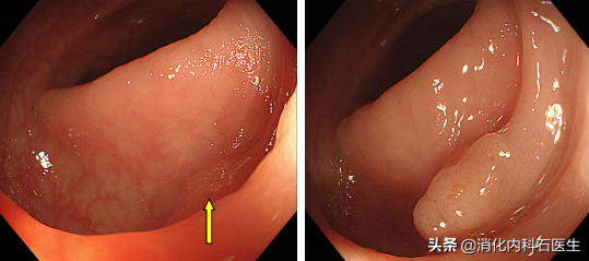 肠镜检查发现结肠息肉3个，做手术时却发现5个，为什么？