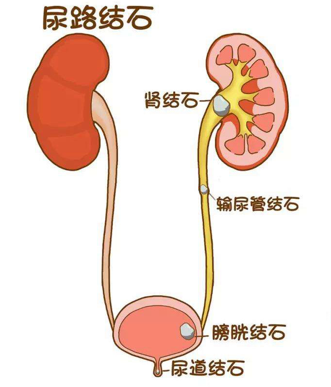 “吃”出来的结石，这些食物再好吃也要节制，管住嘴巴