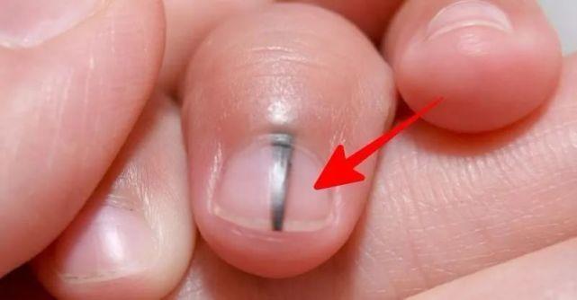 指甲上的白点、竖纹、月牙代表了什么？月牙多的人更健康吗？