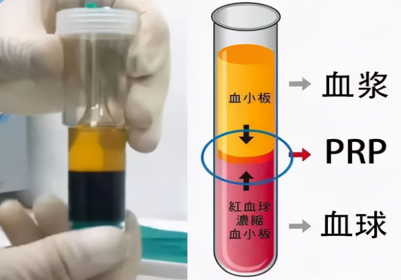 发际线后移怎么办 减缓发际线后移方法