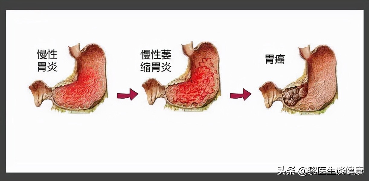 引起胃癌发生的危险因素有哪些？哪些人是高危人群？