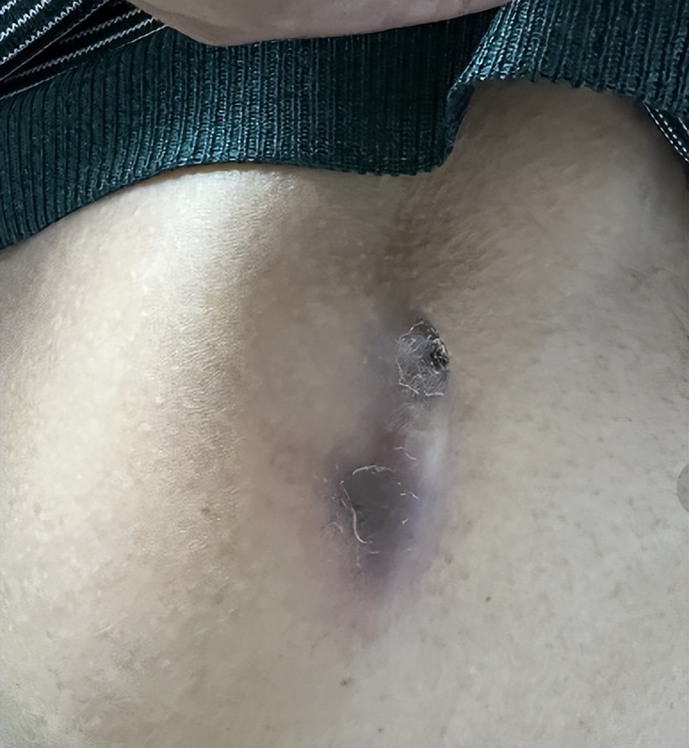 仁医病例丨成功拔除植入9年的除颤电极