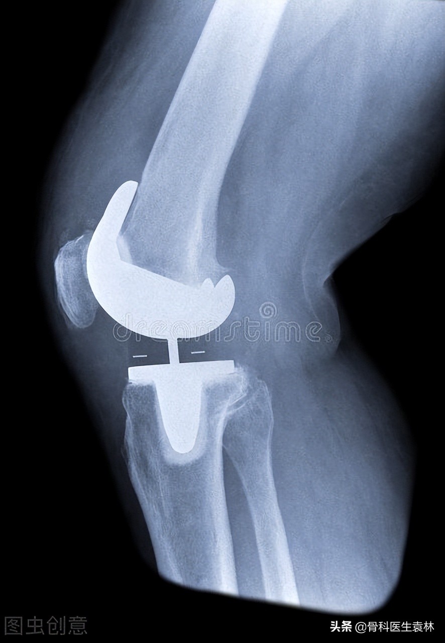 人工膝关节置换安全吗？人工膝关节能够用多久？