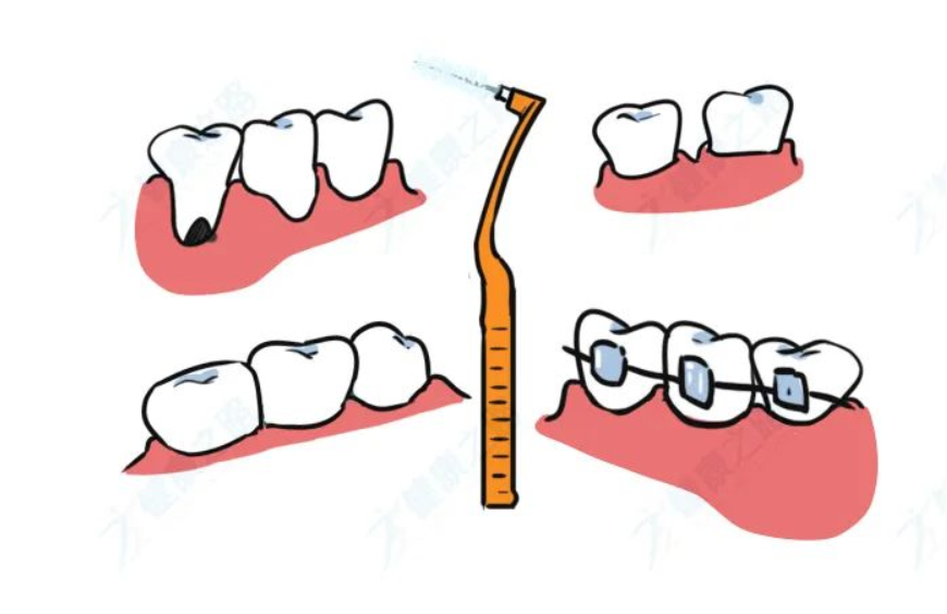 电动牙刷真的有用吗？和普通牙刷有什么不同？别再被忽悠了