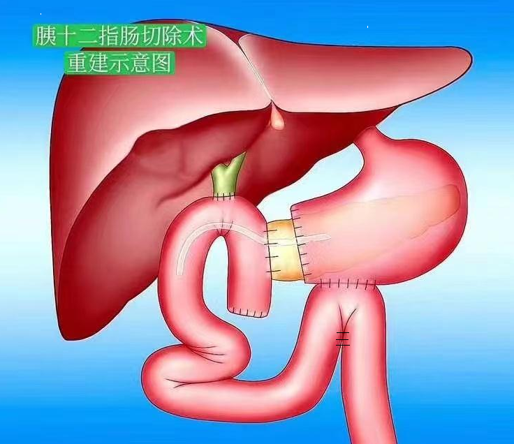 胰十二指肠吻合口图图片