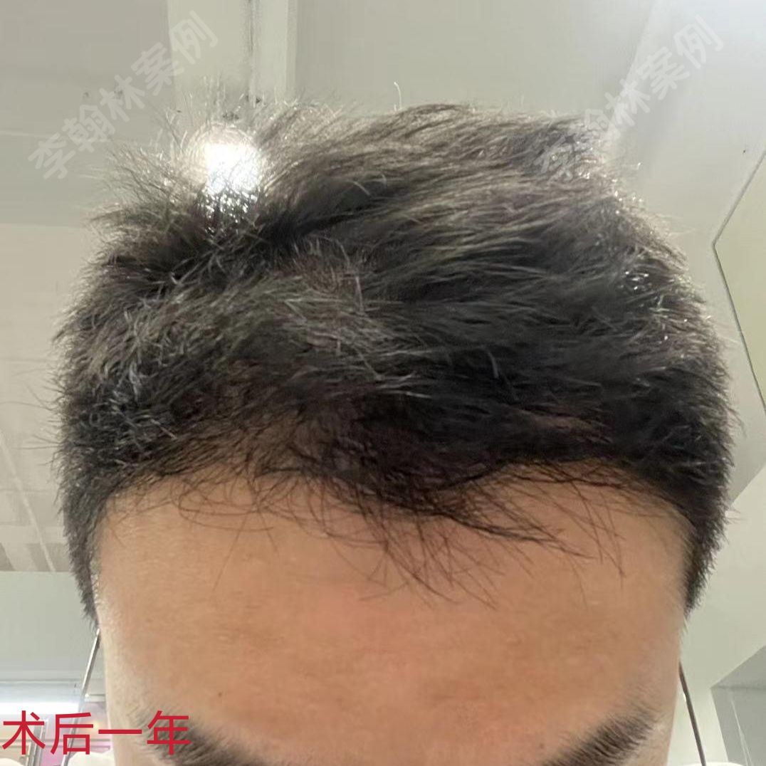 m型发际线植发一年反馈