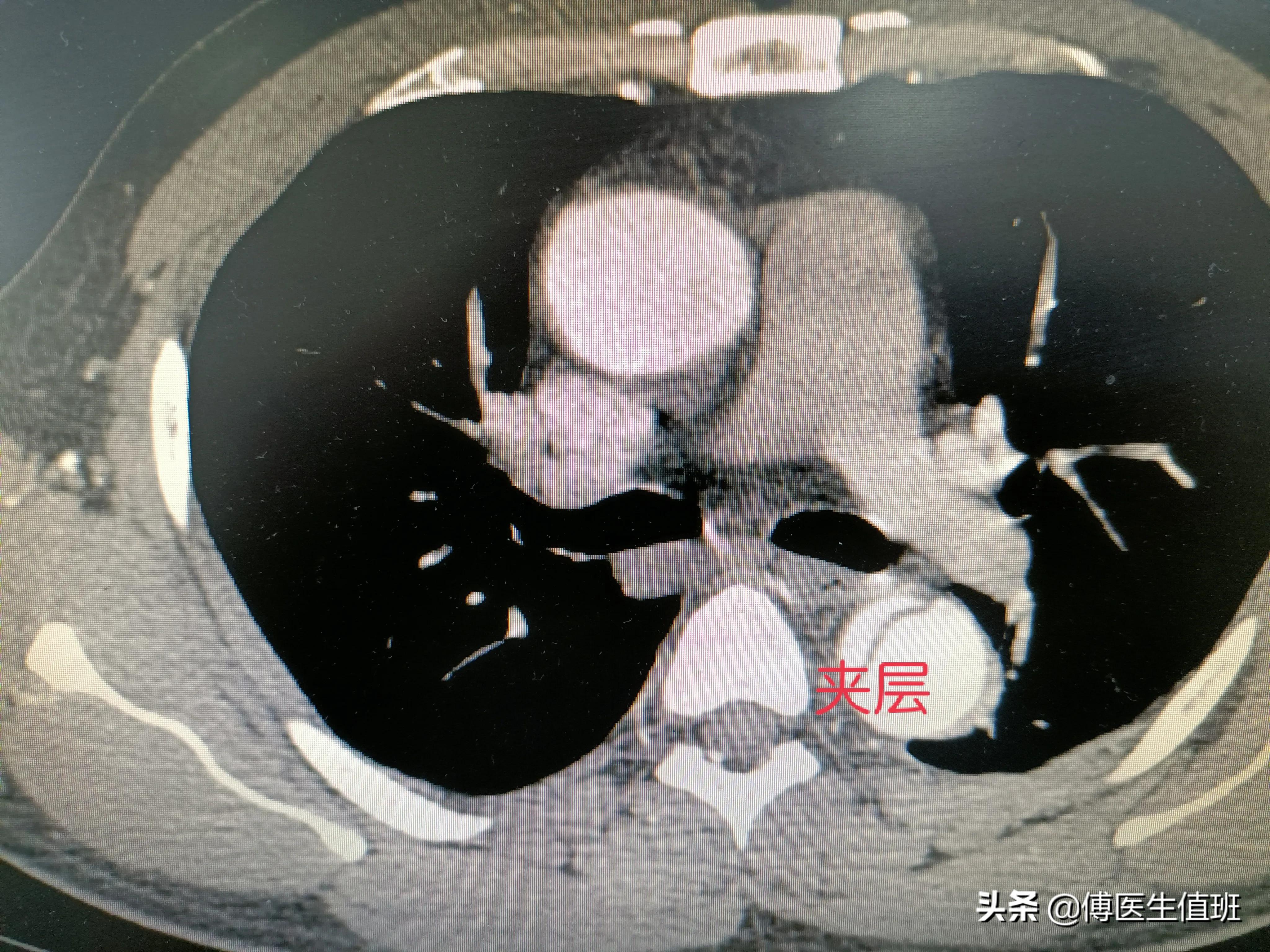 这种类型的夹层也需要急诊手术治疗,因为主动脉夹层有随时破裂的风险