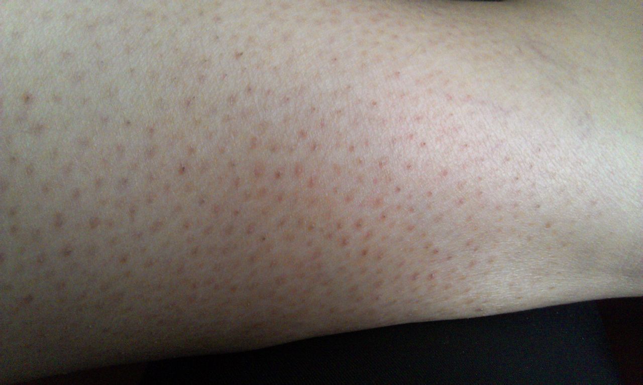 身体有癌，皮肤先报警？提醒：皮肤出现4种异常，或是癌症信号