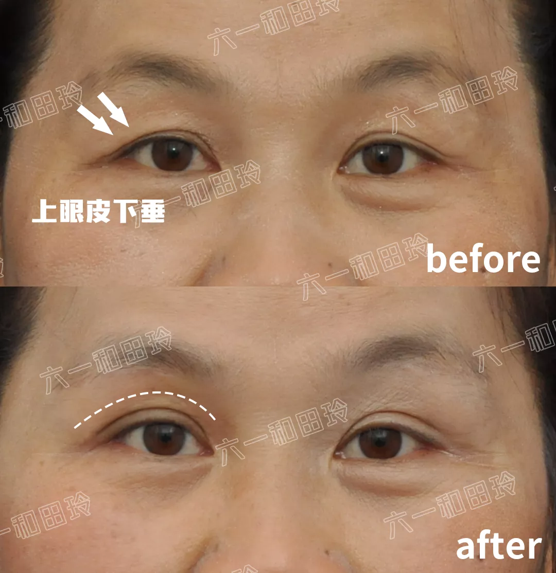过年给妈妈最好的礼物，就是隐形眉眼提升