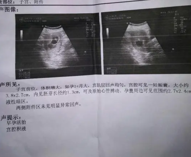 “脑瘫天才”高考262分，每科都只做选择题，如今却成985数学博士